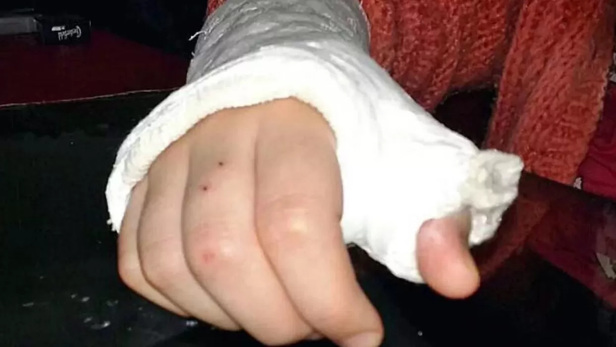 BULLYING. Le quebraron los dedos a una nena en Bahía Blanca. FOTO TOMADA DE TN.