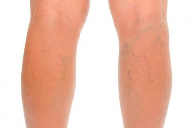 Siete consejos para prevenir la aparición de várices