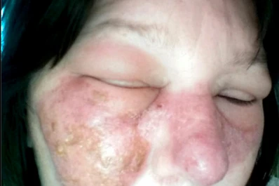 Casi muere de una infección por rascarse la nariz