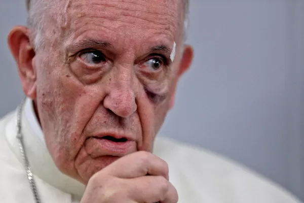 ¿Qué le pasó al papa Francisco en la cara?
