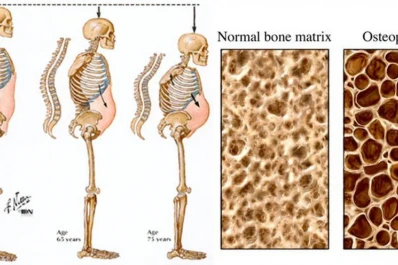 Después de los 50, la mitad de las mujeres y el 20% de los hombres sufre de osteoporosis