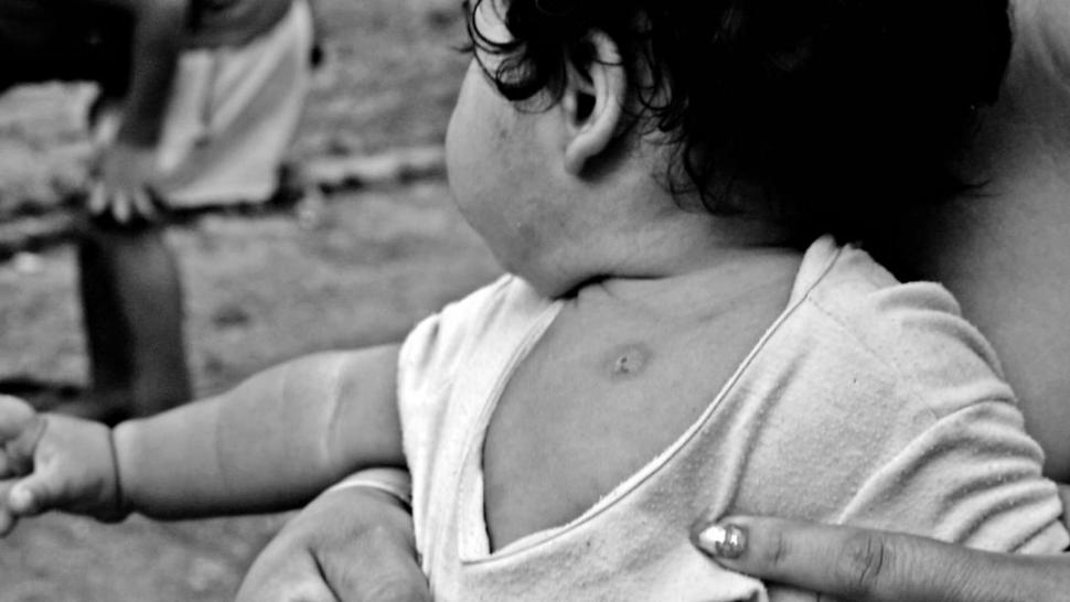 PIODERMITIS. Monteros muestra uno de los granitos que padeció su bebé. la gaceta / foto de Matías quintana 