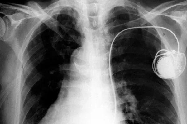 El wifi es un salvavidas de los pacientes con marcapasos