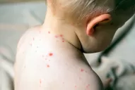 Luego de que se confirmara el caso autóctono de sarampión, desde Salud piden estar en alerta ante los síntomas