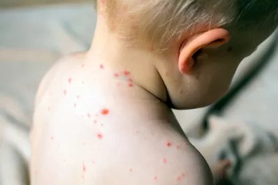 Luego de que se confirmara el caso autóctono de sarampión, desde Salud piden estar en alerta ante los síntomas