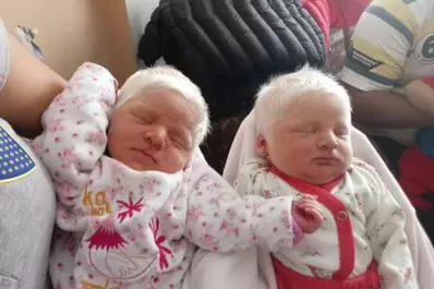 Nacieron mellizas albinas en Tucumán y su foto se volvió viral
