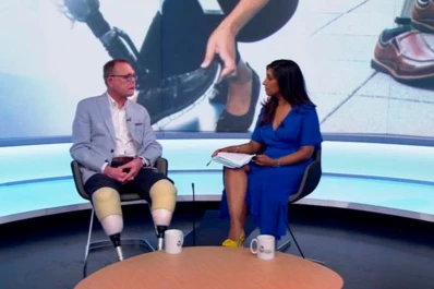 Lo lamió su perro y perdió las dos piernas, los dedos y parte de su cara