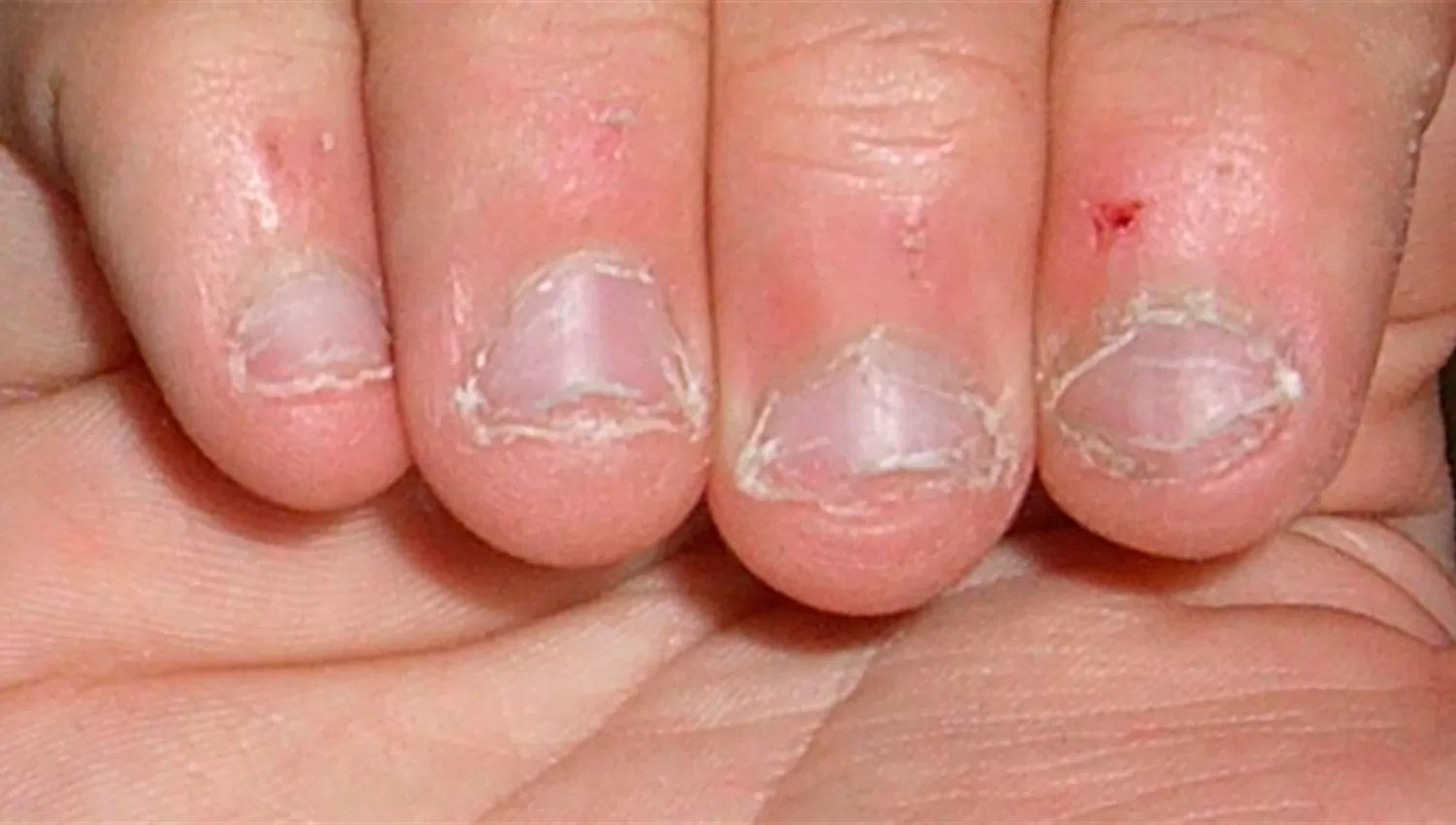 PELIGRO. Onicofagia es el hábito de comerse las uñas.