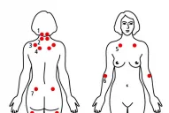 Fibromialgia una guía que ayuda a reconocer la enfermedad