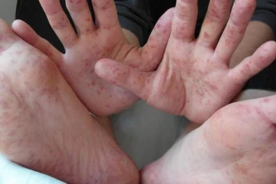 Síndrome manos, pies y boca, el virus que ataca al niño y altera la familia