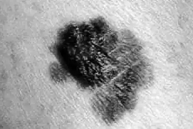 Cáncer de piel: los cambios en los lunares a los que deberías prestarles atención