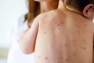 Dos casos de sarampión autóctono encendieron las alarmas