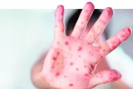 Sarampión: recomendaciones para prevenir la enfermedad