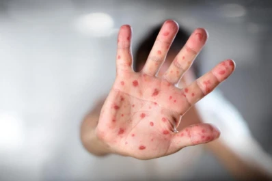 Sarampión: qué hay que hacer para evitar un brote
