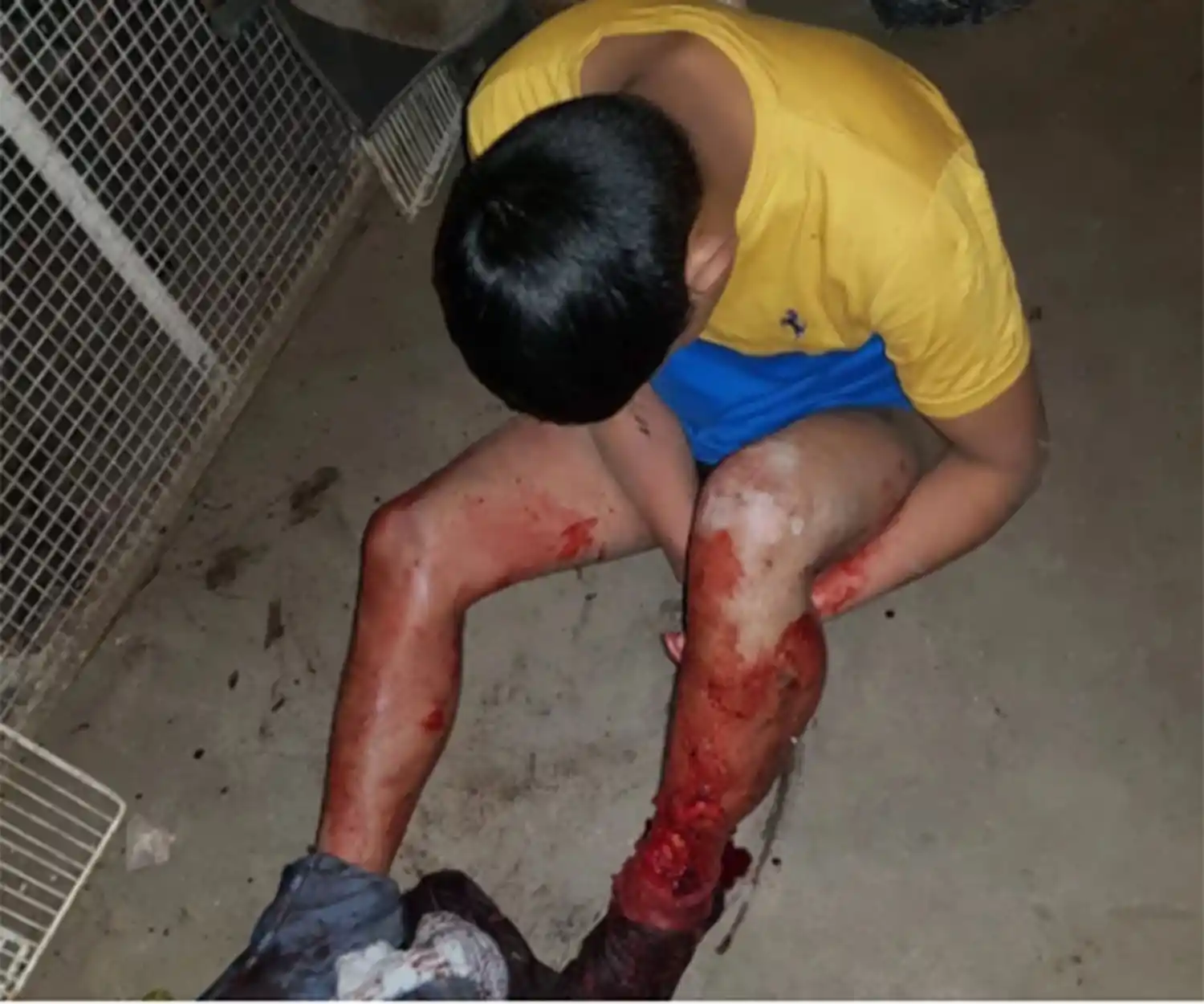 Entró a robar en la casa de una jubilada y un pitbull le destrozó la pierna