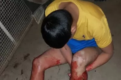 Entró a robar en la casa de una jubilada y un pitbull le destrozó la pierna