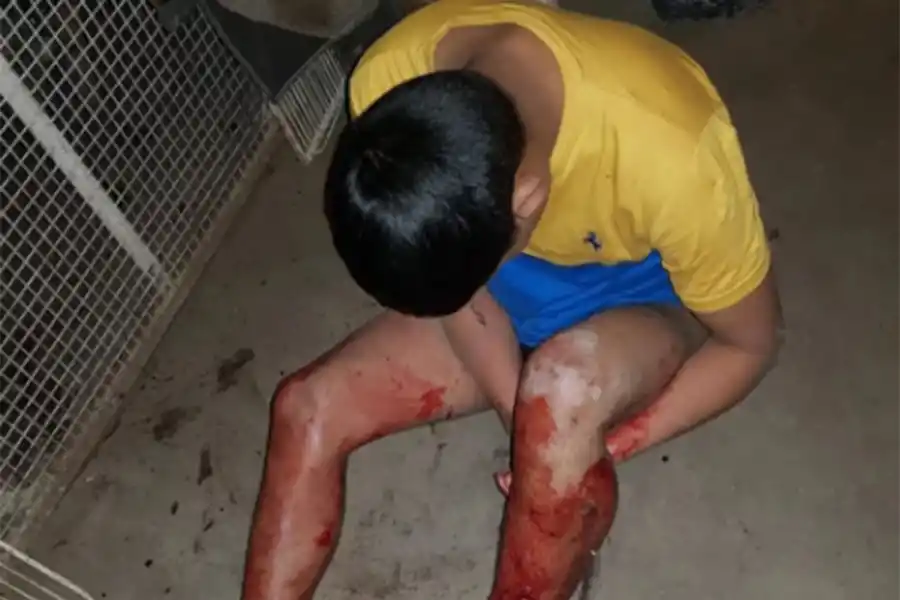 Entró a robar en la casa de una jubilada y un pitbull le destrozó la pierna