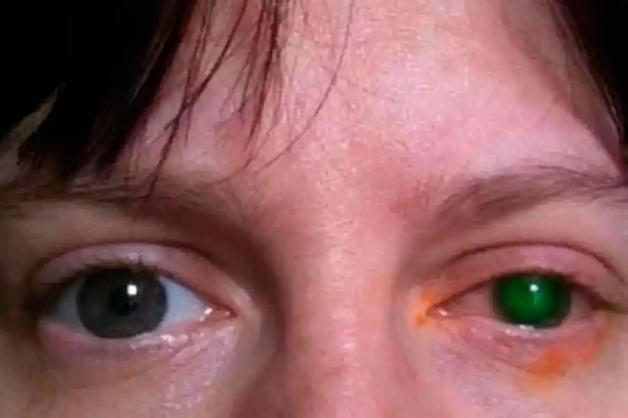 ASÍ QUEDÓ. La mirada de Emma luego del trasplante.