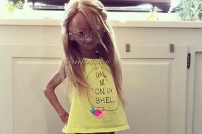 El caso de Adalia Rose, con envejecimiento prematuro, conmueve al mundo