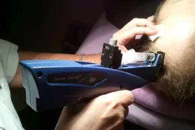 Qué es el plasma rico en plaquetas y qué beneficios le da al cuerpo