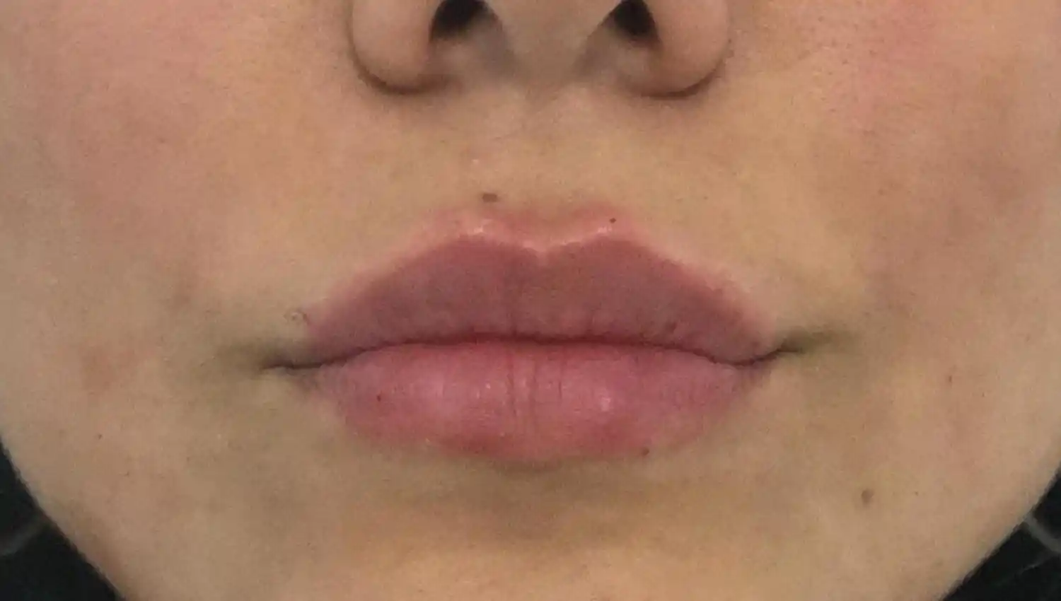 ÁCIDO HIALURÓNICO. Sirve para rellenar las zonas con colágeno perdido.