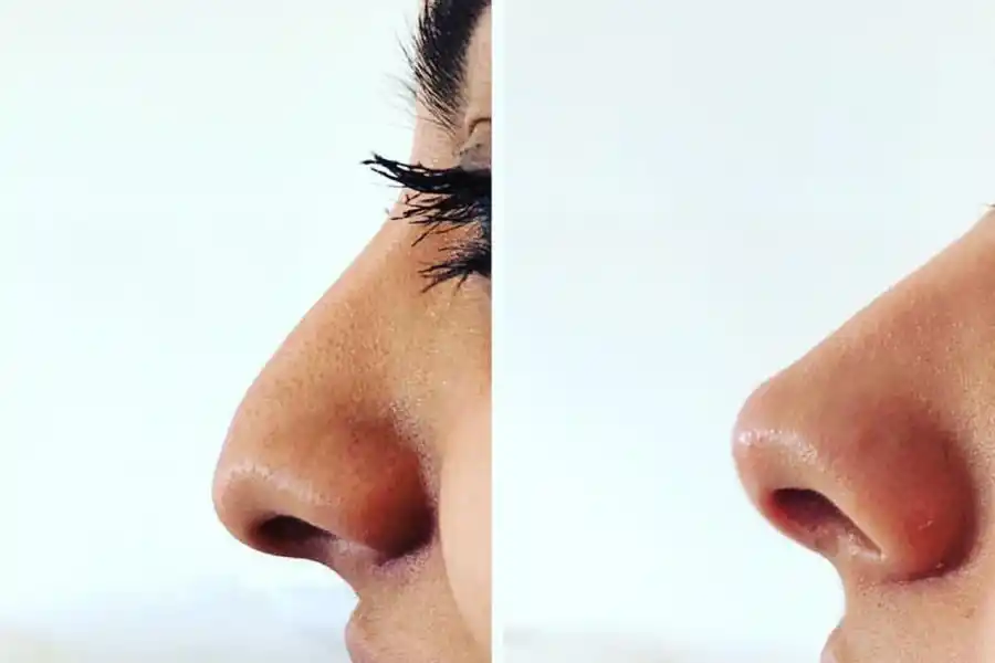 RINOMODELACIÓN. La intervención no quirúrgica que corrige la nariz. 