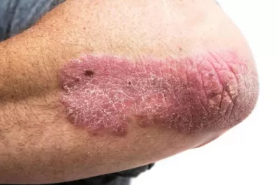 Consulta gratuita y sin turno para detectar psoriasis