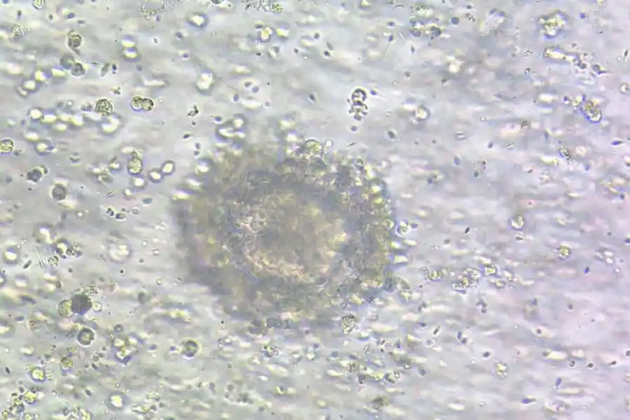 LA MEDICINA REPRODUCTIVA DA RESPUESTAS EFECTIVAS. Cerca de la mitad de los tratamientos de fertilidad asistida que se realizan en al menos un centro especializado se llevan a cabo en base a la donación de óvulos. 