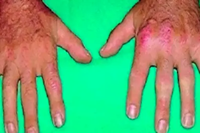 ¿Tenés dudas? Consultá gratis si padecés artritris psoriásica