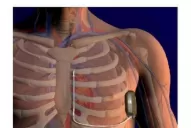 En qué casos sirve colocar un desfibrilador