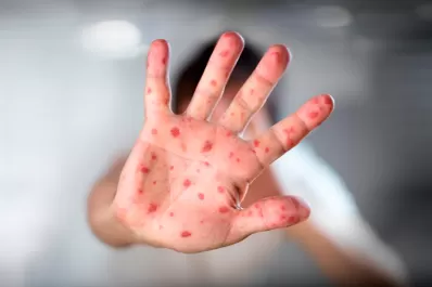 Aseguran que el brote de sarampión fue controlado y que el país está libre de esa enfermedad