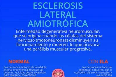 ELA, un mal sin cura y del que se sabe poco