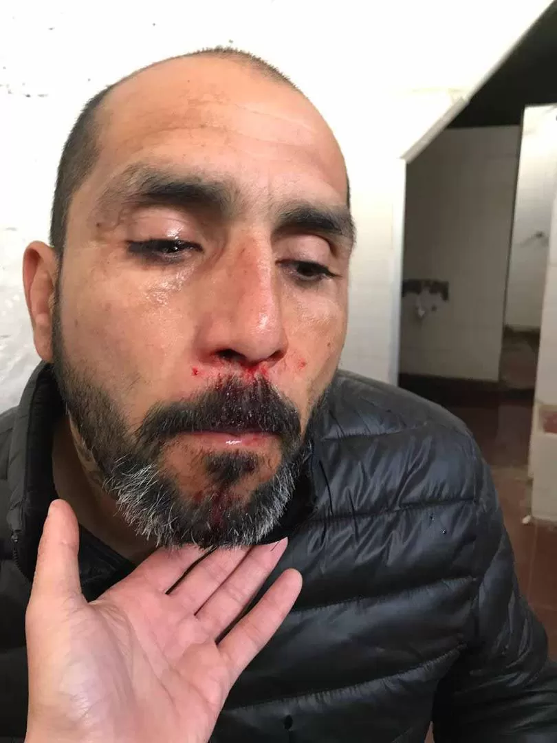 INSÓLITO. Gustavo Ibáñez sufrió la fractura de tabique nasal tras ser agredido por el arquero Gabriel Ortiz, de San Fernando.  
