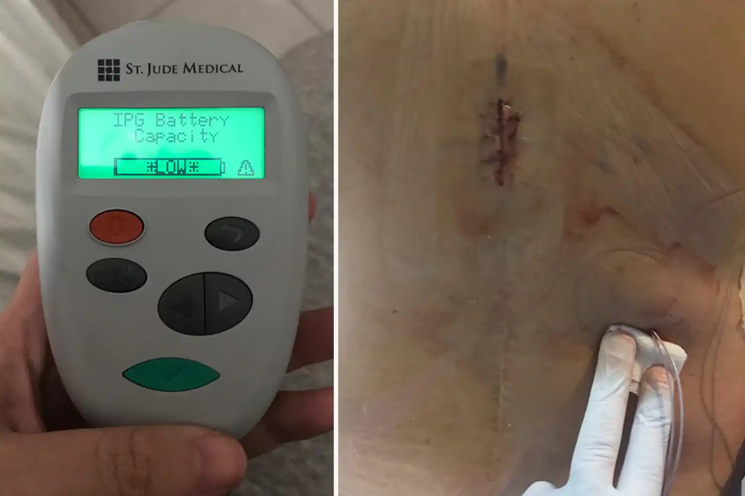 ESTÁ BIEN. El neuroestimulador ayuda a calmar en Belén un dolor insoportable.