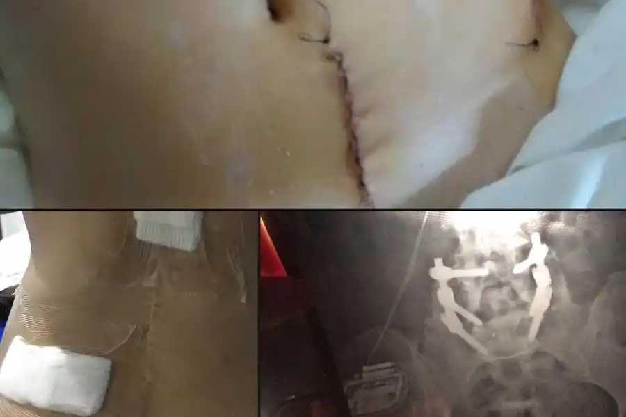 UN CALVARIO. El desplazamiento de una vértebra le costó tres operaciones a Belén.