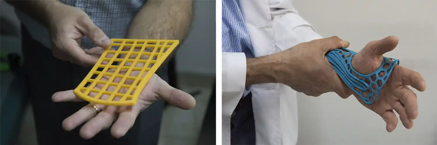 Las férulas a medida de los pacientes se imprimen y luego se moldean con calor para que se adapten a la anatomía.