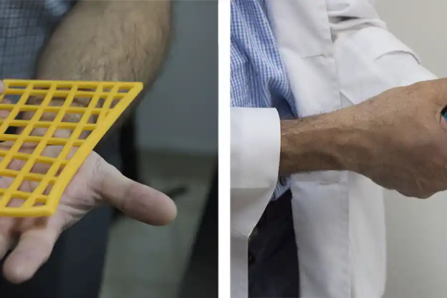 Las férulas a medida de los pacientes se imprimen y luego se moldean con calor para que se adapten a la anatomía.