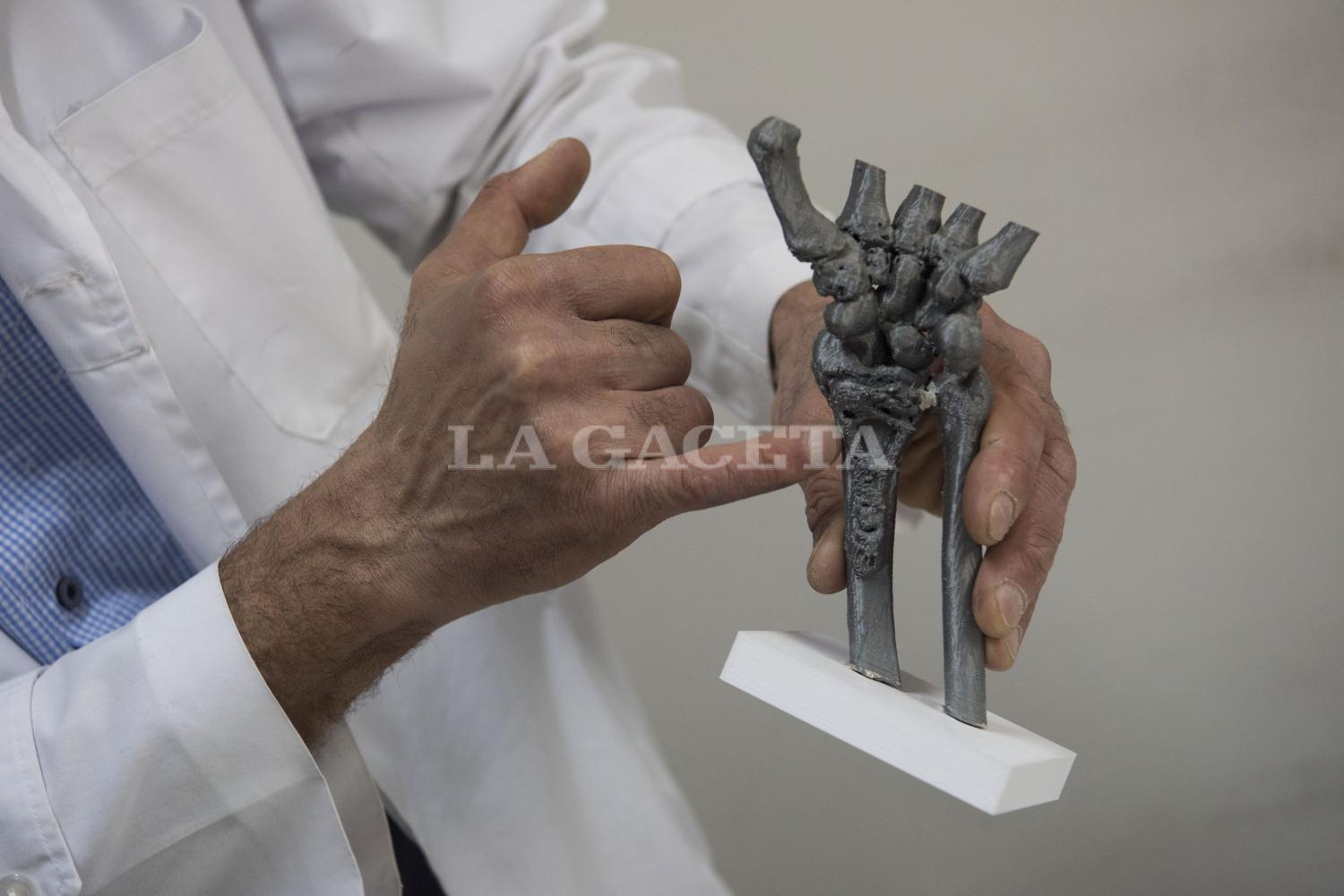 Claudio Brahim muestra la impresión tridimensional de una mano fracturada, que sirvió para planificar la cirugía.