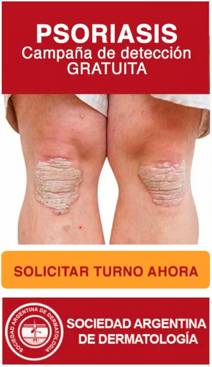 Otorgan turnos gratuitos en Tucumán para detectar pacientes con psoriasis