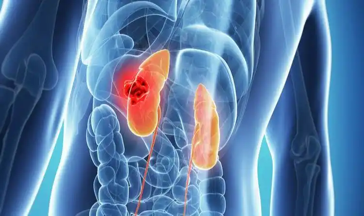 Una alternativa terapéutica para el carcinoma de células renales