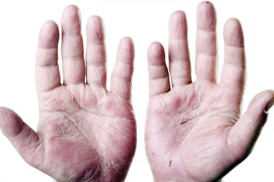 Actividades por el Día Mundial de la Psoriasis, que se conmemora el 29