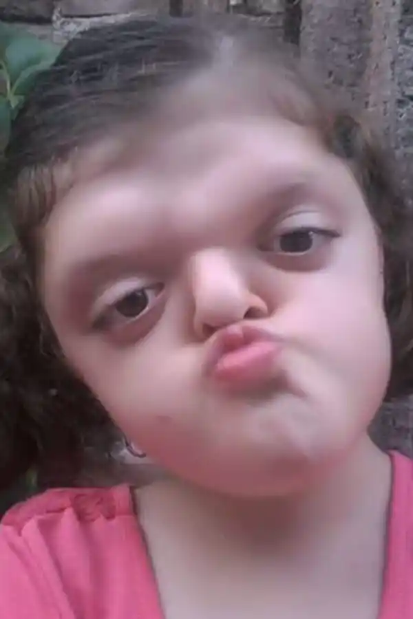 SARITA. Tiene 9 años y síndrome de Apert.