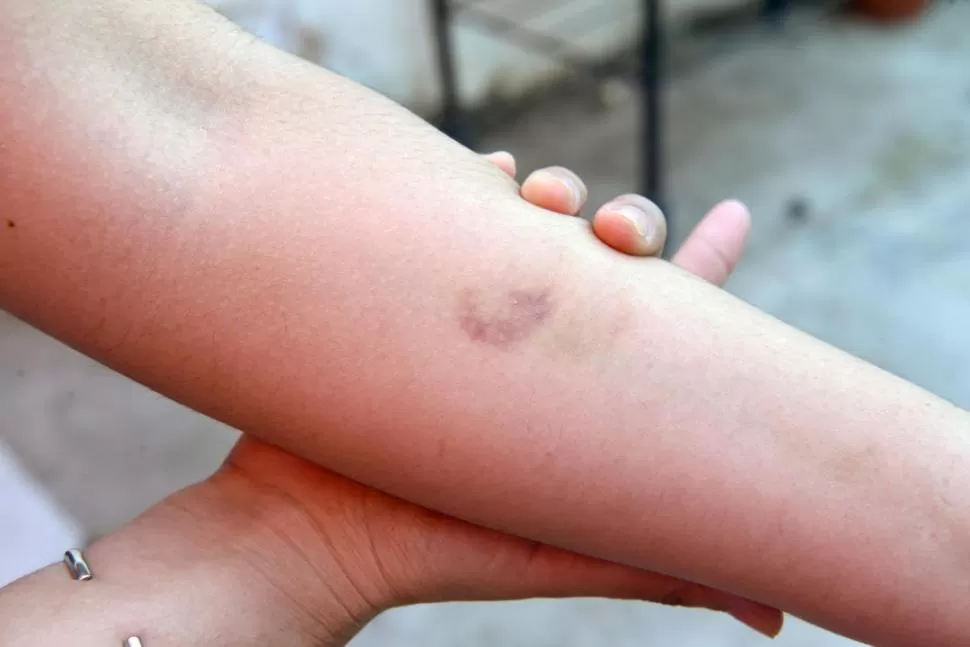 LESIÓN. La joven muestra el hematoma en su antebrazo izquierdo, que se debió al tironeo de un agente, según relató. la gaceta / fotos de analia jaramillo 