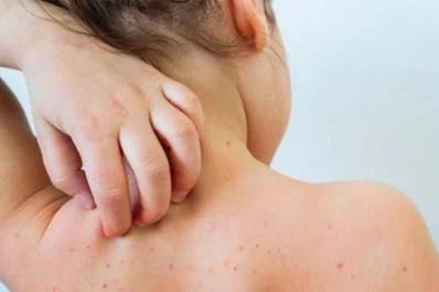 Los casos de sarampión siguen aumentando