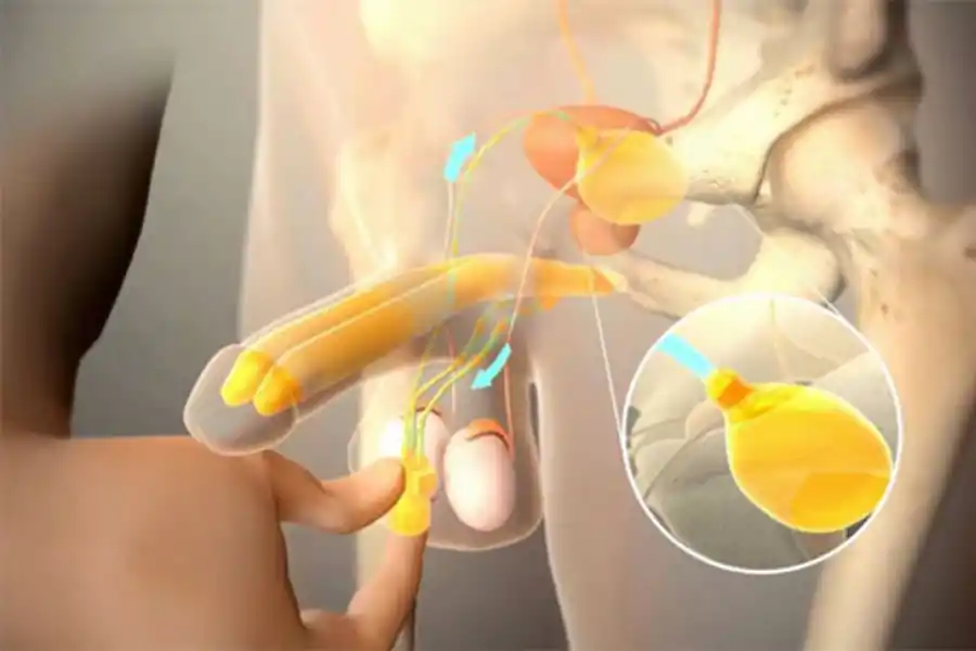 Diagrama del funcionamiento de la prótesis de pene.