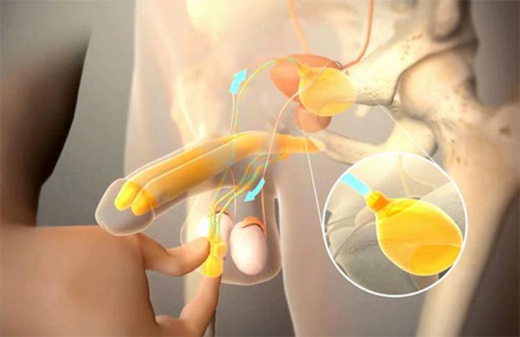Diagrama del funcionamiento de la prótesis de pene.