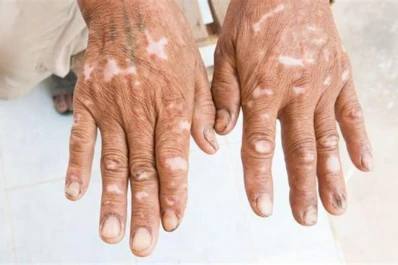 Esclerodermia: no sólo en la piel