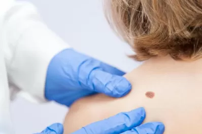 Salud: logran un nuevo tratamiento para melanomas avanzados