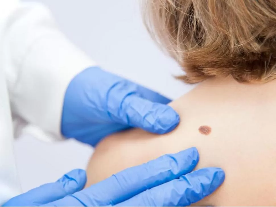 RIESGOS. El melanoma es el tipo más grave del cáncer de piel. En el país causa cerca de 600 muertes por año. 
