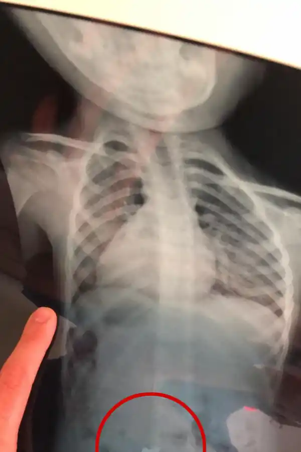 SUSTO. La radiografía de Maitena mostró que se había tragado un tornillo. Por suerte pasó rápido el esófago y luego lo despidió.